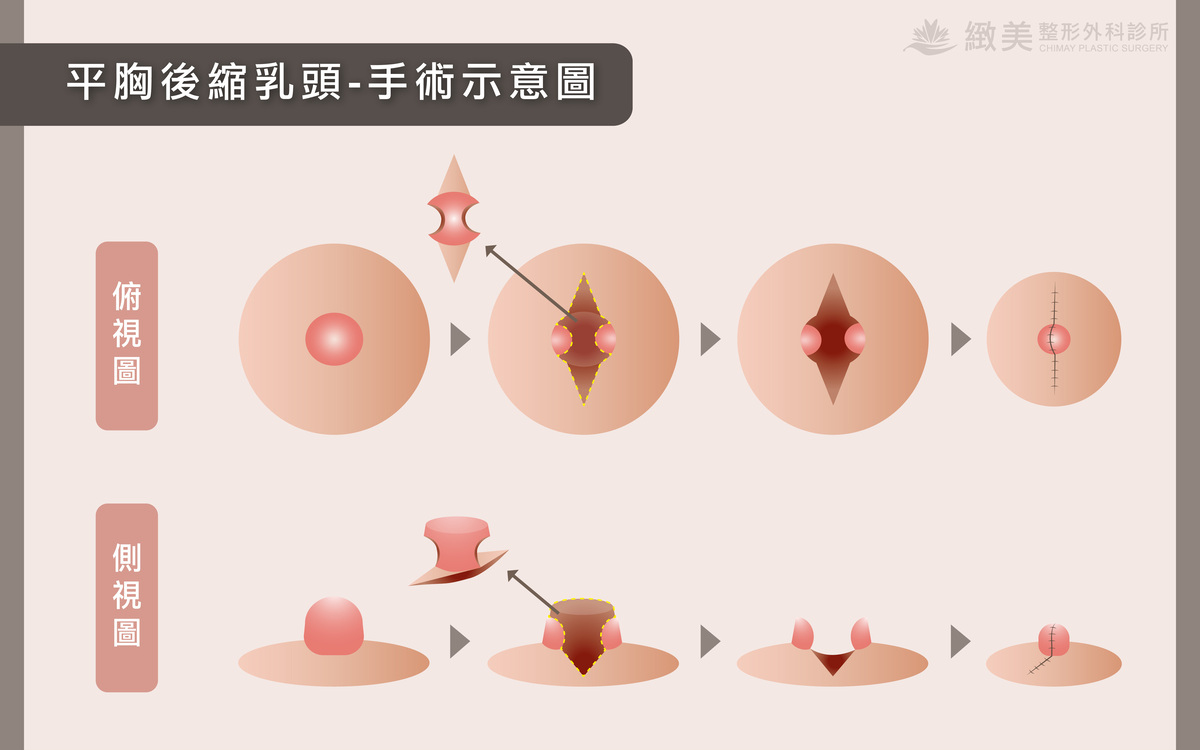 平胸後縮乳頭-手術示意圖