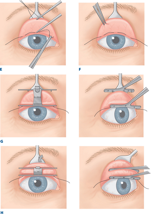 提眼瞼肌手術方式 - 內開式