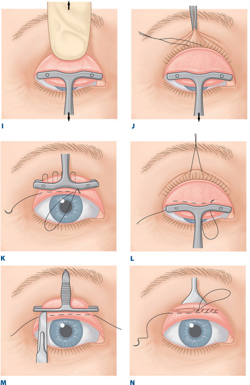 提眼瞼肌手術方式 - 內開式