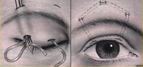 提眼瞼肌手術方式 - 額肌懸吊式