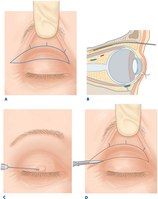 提眼瞼肌手術方式 - 外開式