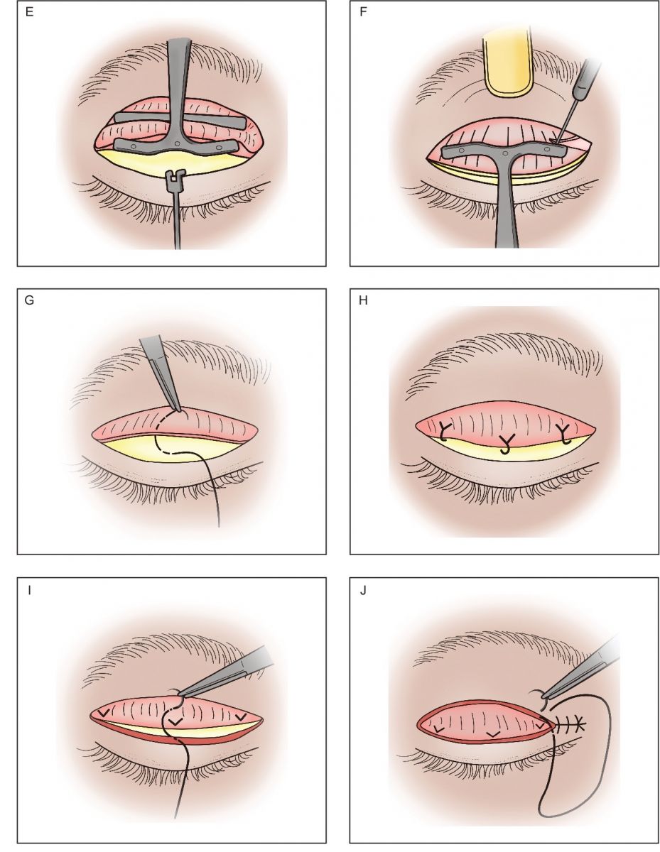 提眼瞼肌手術方式 - 外開式
