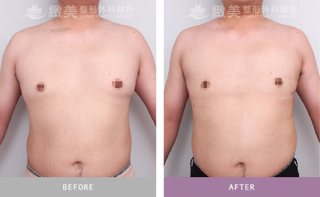 男性女乳矯正術後 3個月