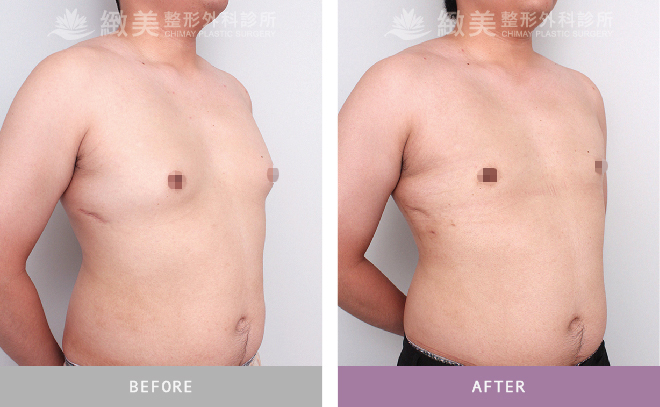男性女乳矯正術後 3個月