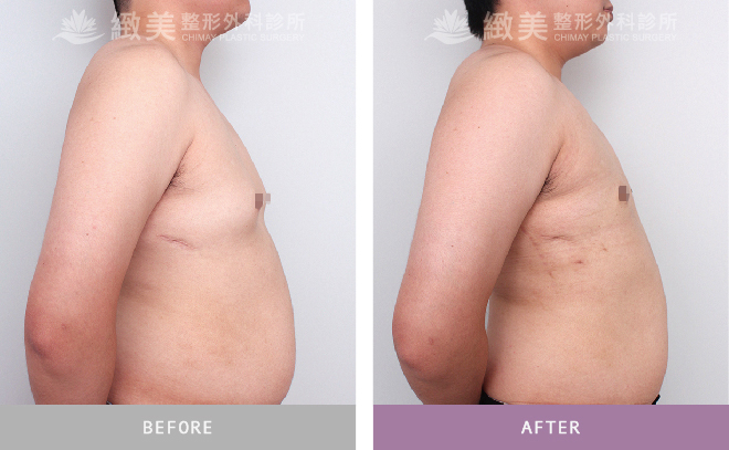 男性女乳矯正術後 3個月