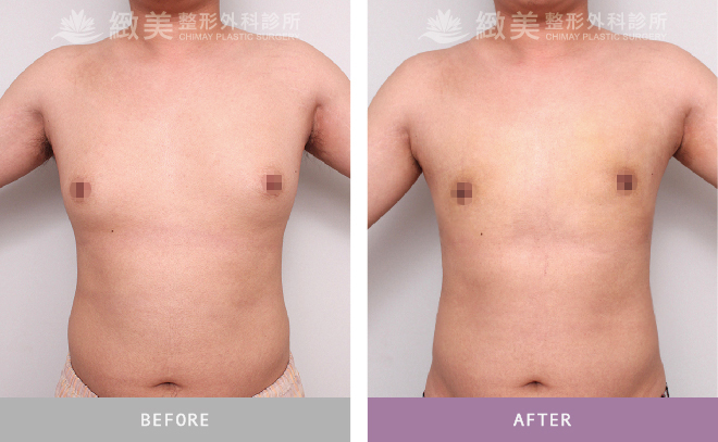 男性女乳矯正術後 3個月