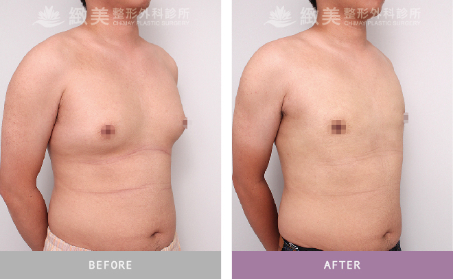 男性女乳矯正術後 3個月