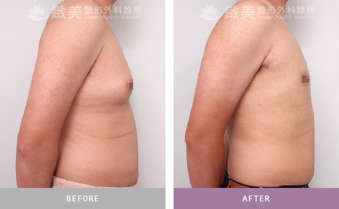 男性女乳矯正術後 3個月