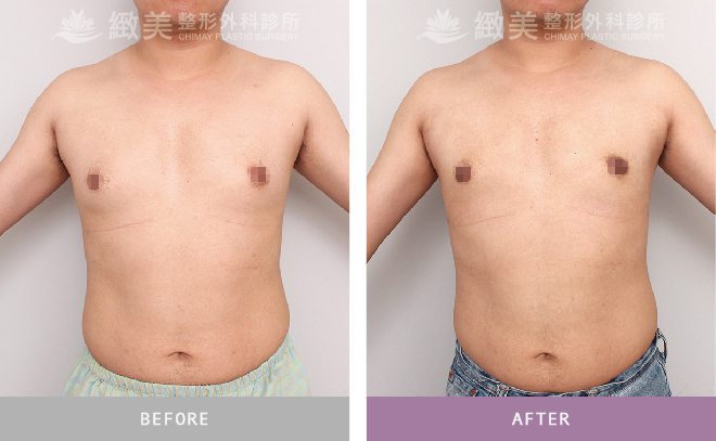 男性女乳矯正術後 3個月