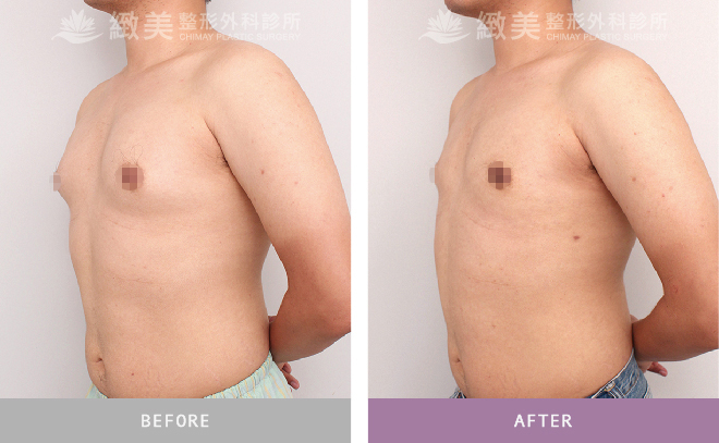 男性女乳矯正術後 3個月