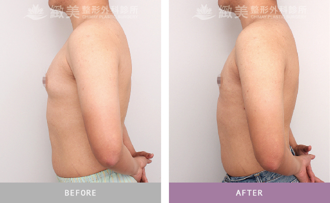 男性女乳矯正術後 3個月