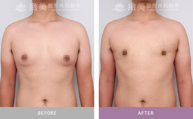 男性女乳矯正術後 半年