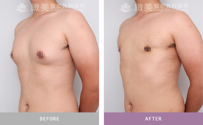 男性女乳矯正術後 半年