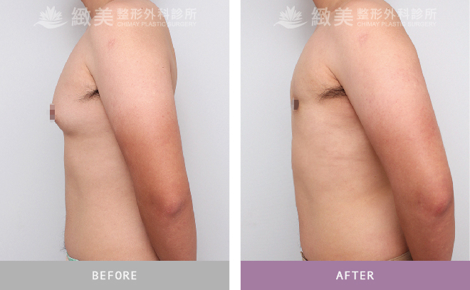 男性女乳矯正術後 半年