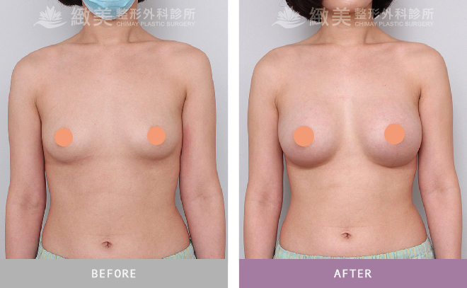 水滴型果凍矽膠隆乳 術後2個月