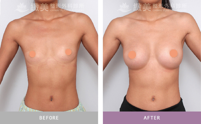 水滴型果凍矽膠隆乳 術後半年