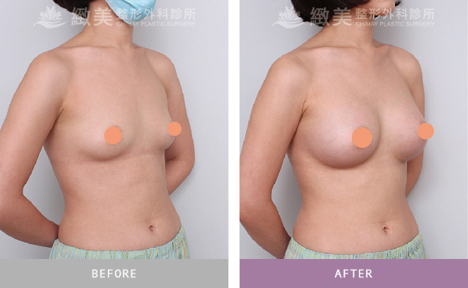 水滴型果凍矽膠隆乳 術後2個月