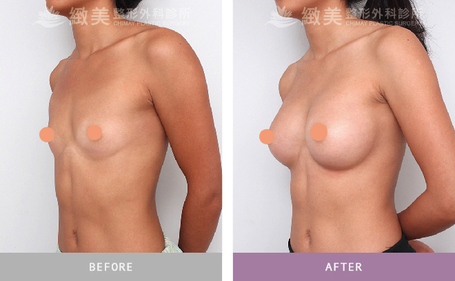 水滴型果凍矽膠隆乳 術後半年