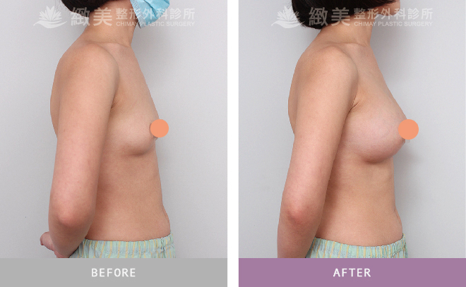 水滴型果凍矽膠隆乳 術後2個月