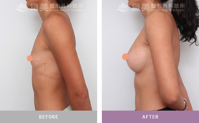 水滴型果凍矽膠隆乳 術後半年