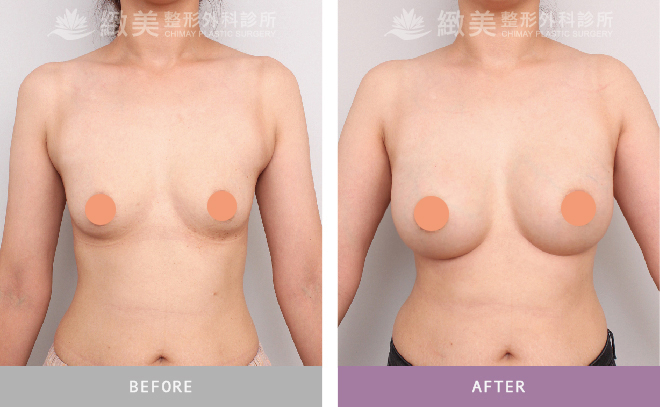 水滴型果凍矽膠隆乳術後 半年