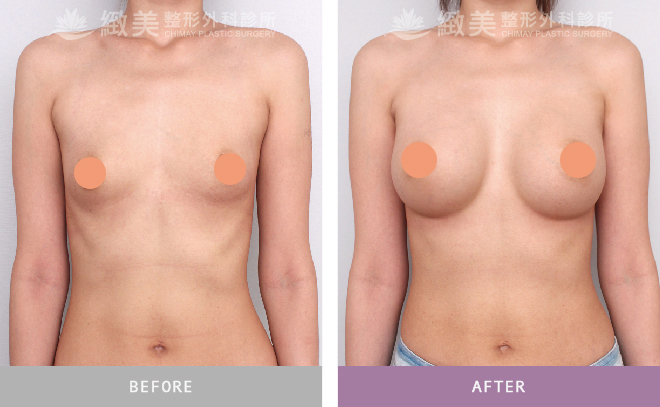 水滴型果凍矽膠隆乳術後 3個月