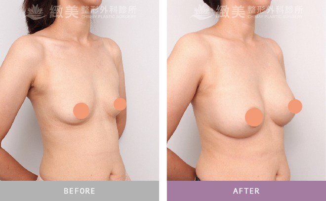 水滴型果凍矽膠隆乳術後 半年