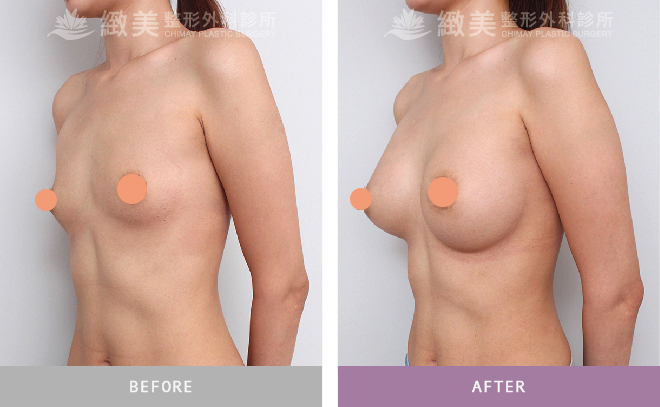 水滴型果凍矽膠隆乳術後 3個月