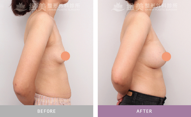 水滴型果凍矽膠隆乳術後 半年