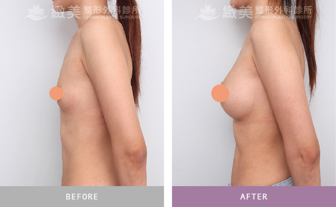 水滴型果凍矽膠隆乳術後 3個月