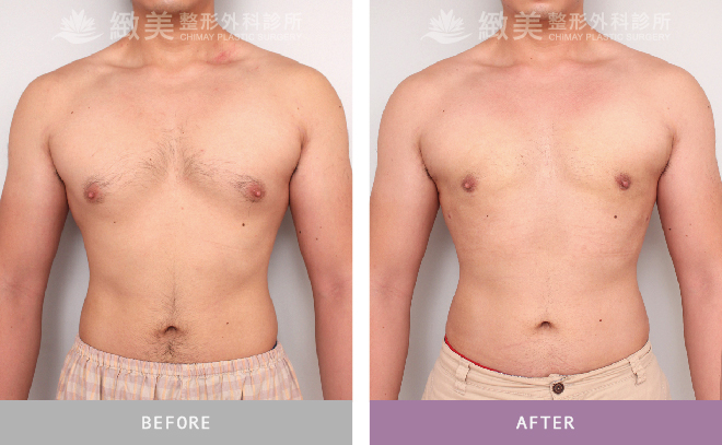 男性女乳矯正術後 1個月
