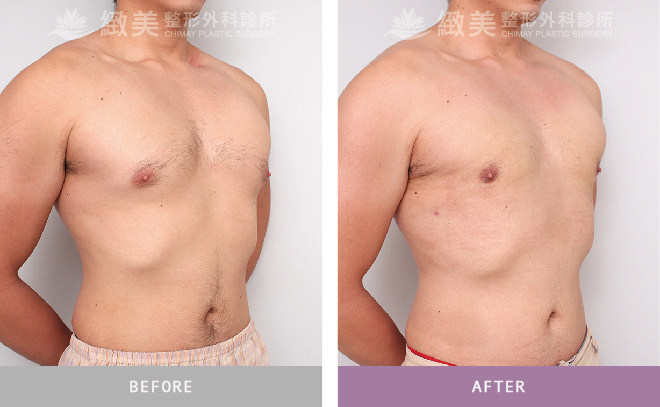 男性女乳矯正術後 1個月