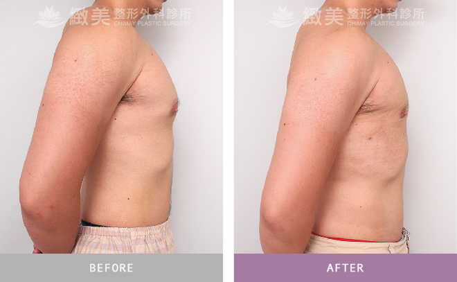 男性女乳矯正術後 1個月