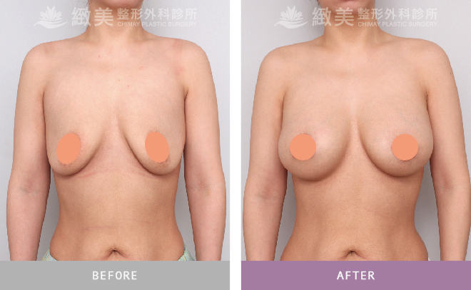 水滴型隆乳+提乳術後 1個月