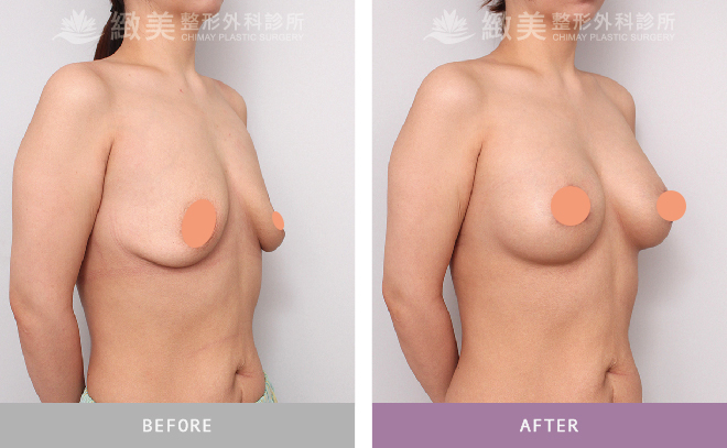 水滴型隆乳+提乳術後 1個月