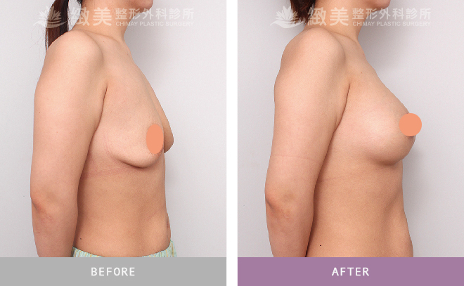 水滴型隆乳+提乳術後 1個月