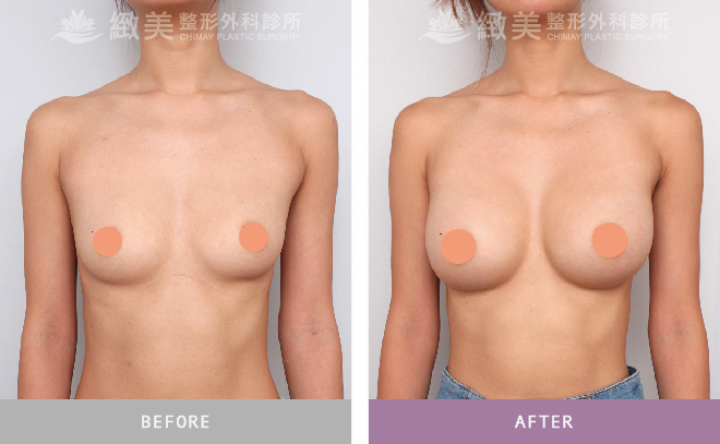 水滴型果凍矽膠隆乳術後 8個月