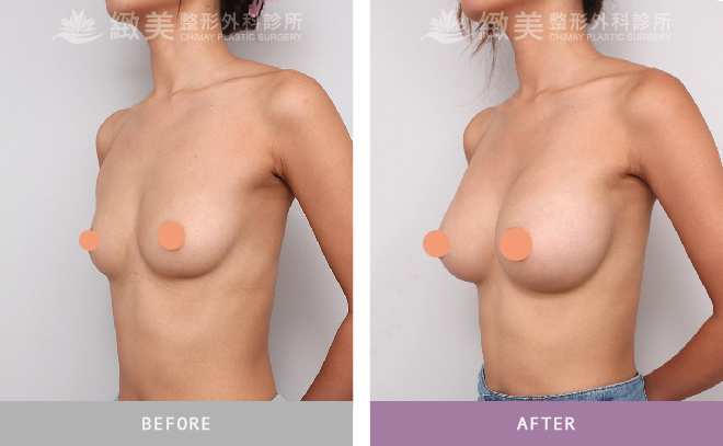 水滴型果凍矽膠隆乳術後 8個月