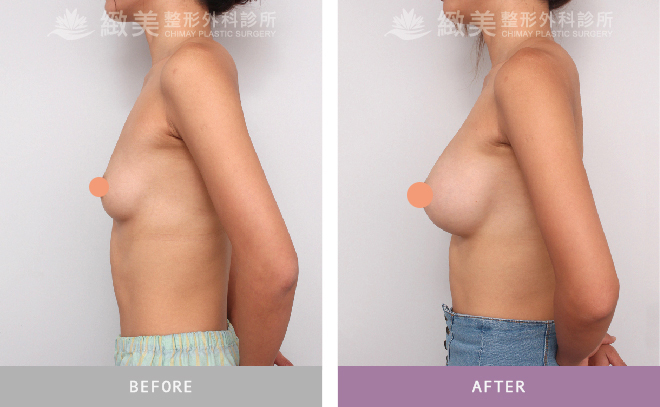 水滴型果凍矽膠隆乳術後 8個月