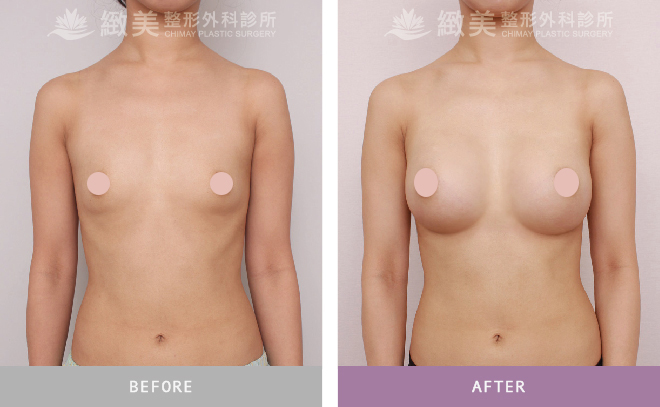 水滴型果凍矽膠隆乳 術後3個月