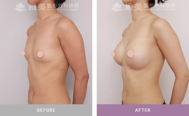 水滴型果凍矽膠隆乳 術後3個月