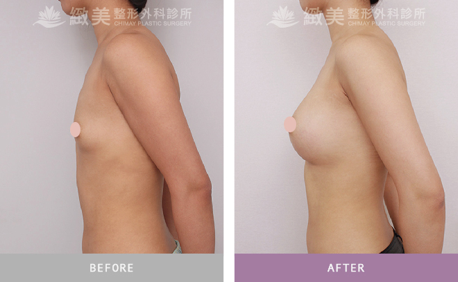 水滴型果凍矽膠隆乳 術後3個月