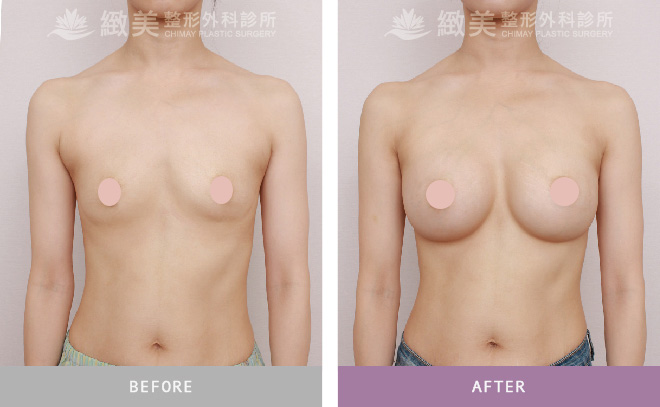 水滴隆乳+副乳抽脂 術後3個月