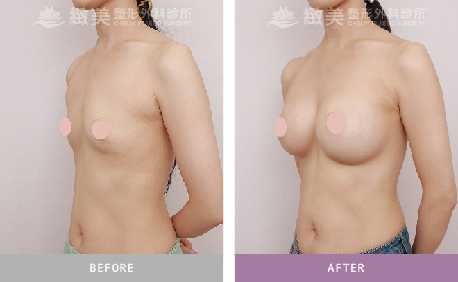 水滴隆乳+副乳抽脂 術後3個月