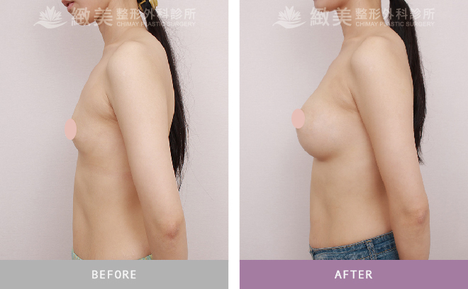水滴隆乳+副乳抽脂 術後3個月