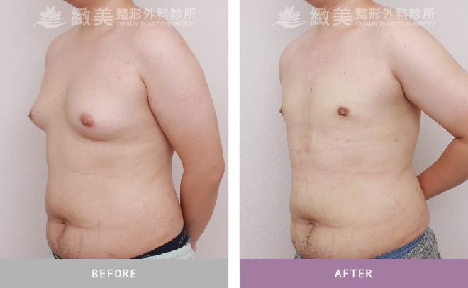 男性女乳矯正術後 3個月