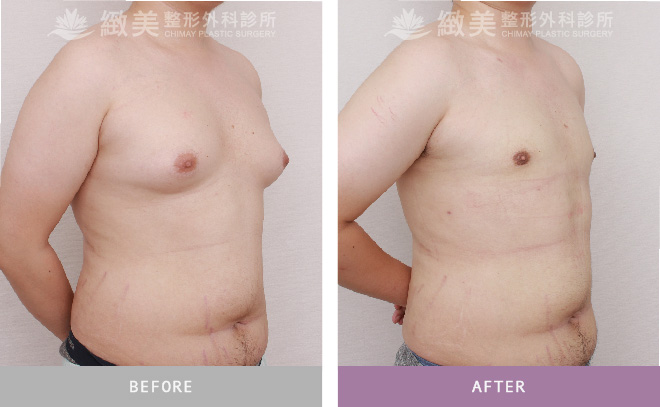 男性女乳矯正術後 3個月