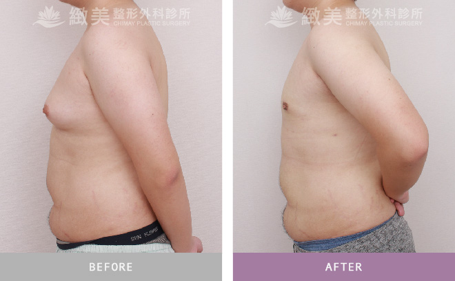 男性女乳矯正術後 3個月