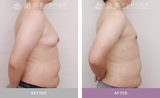 男性女乳矯正術後 3個月