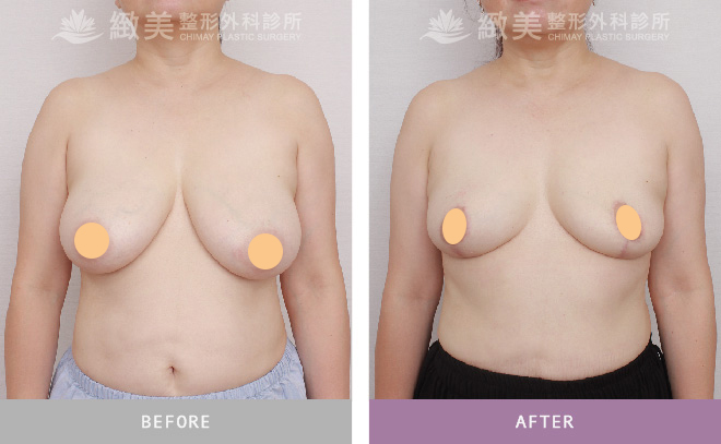 縮乳手術案例_術後7個月
